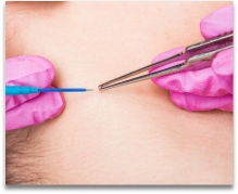 Exerese de fibroma mole