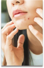 Acnes e Espinhas
