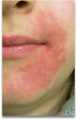 Dermatites
